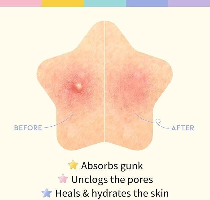 30 Pcs Pimple Patches